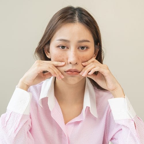 Lupus Adalah: Gejala, Penyebab, dan Pengobatan