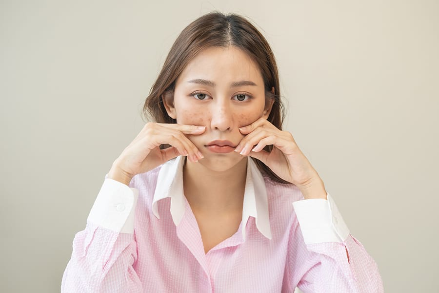 Pengertian Lupus Adalah: Gejala, Penyebab, dan Pengobatan