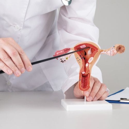 5 Perbedaan PCO dan PCOS, Jangan Sampai Keliru!