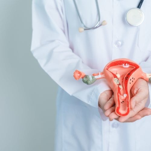 Apa Itu Fibroid Rahim (Miom)? Penyebab, Gejala, Pengobatan
