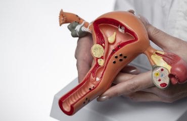 Oophoritis Peradangan Ovarium