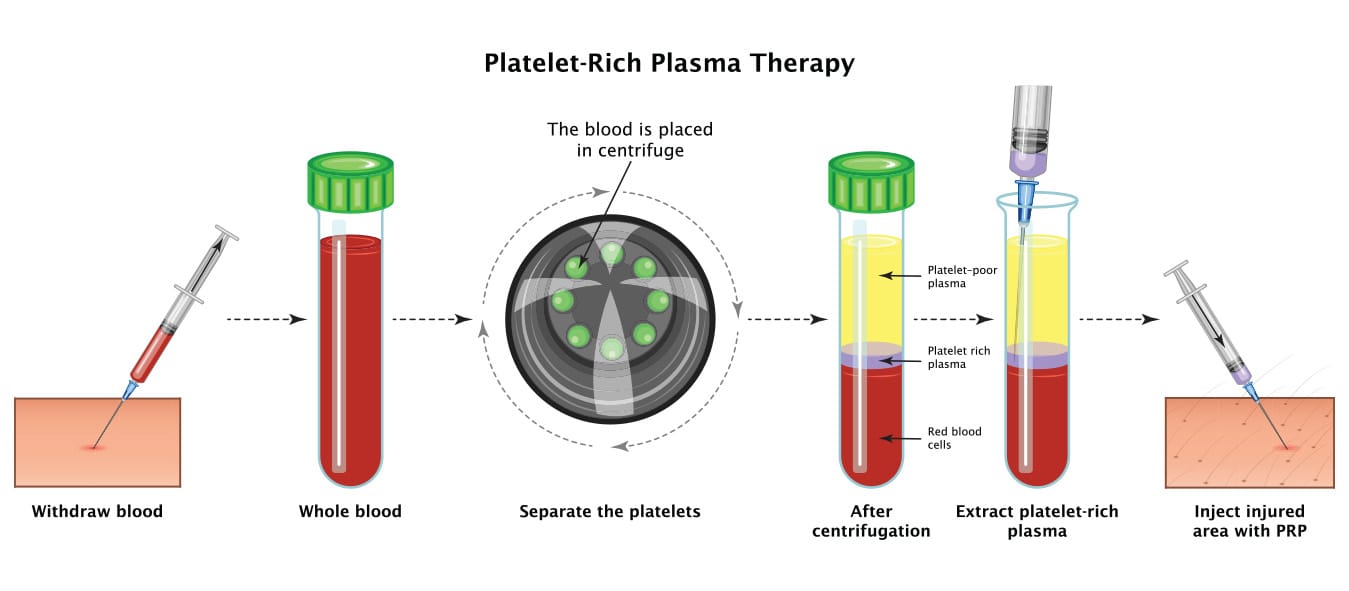 prp ovarium prp ovarium
