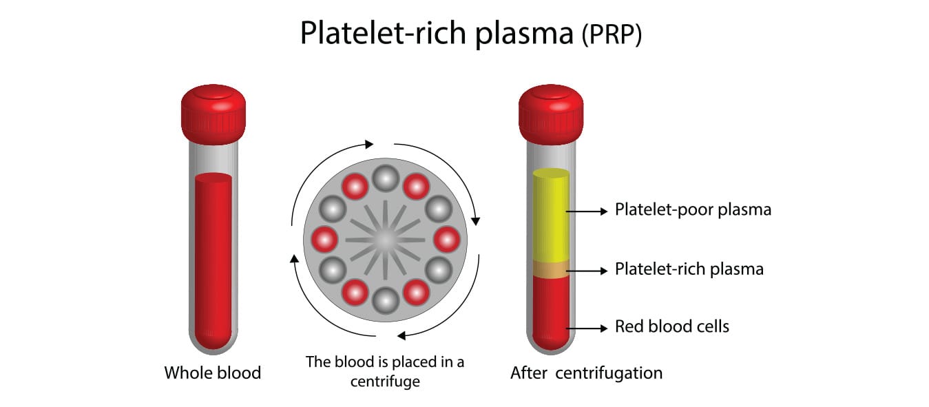 prp ovarium prp ovarium