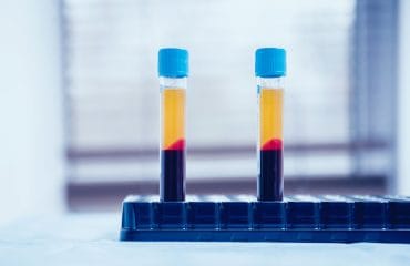 Platelets Rich Plasma Ovarium