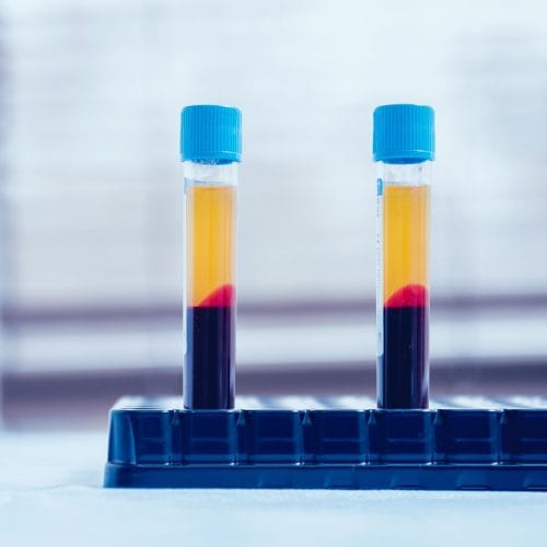 Platelets Rich Plasma Ovarium: Prosedur, Manfaat, dan Efektivitas