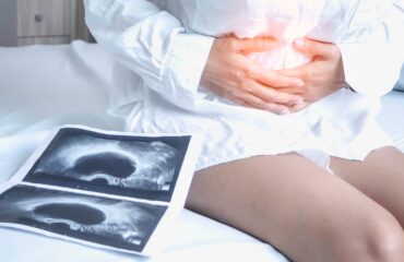 Jenis-Jenis Kista Ovarium: Dari Fungsional hingga Patologis 